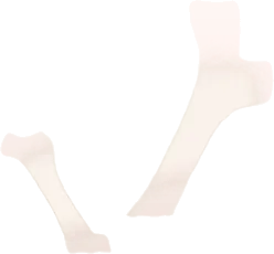 刺さった骨の画像